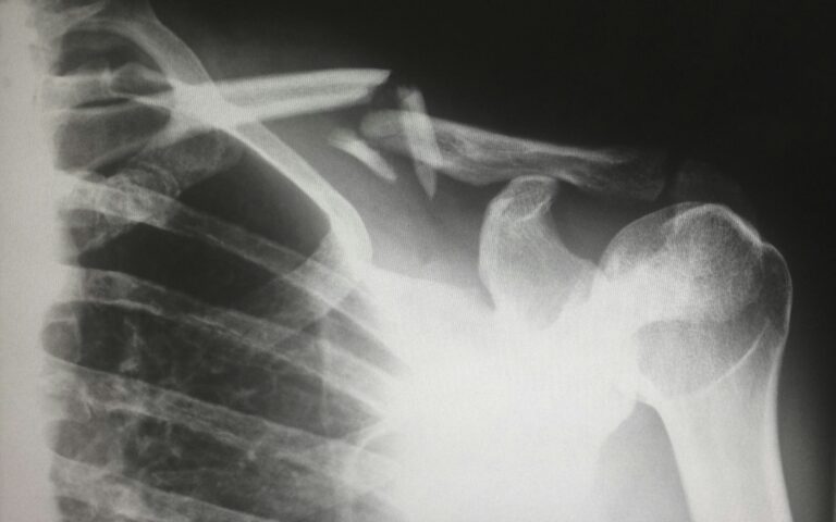 Categories 6 An X-ray of a human shoulder reveals a personal injury: a fractured clavicle with noticeable misalignment of the bone.