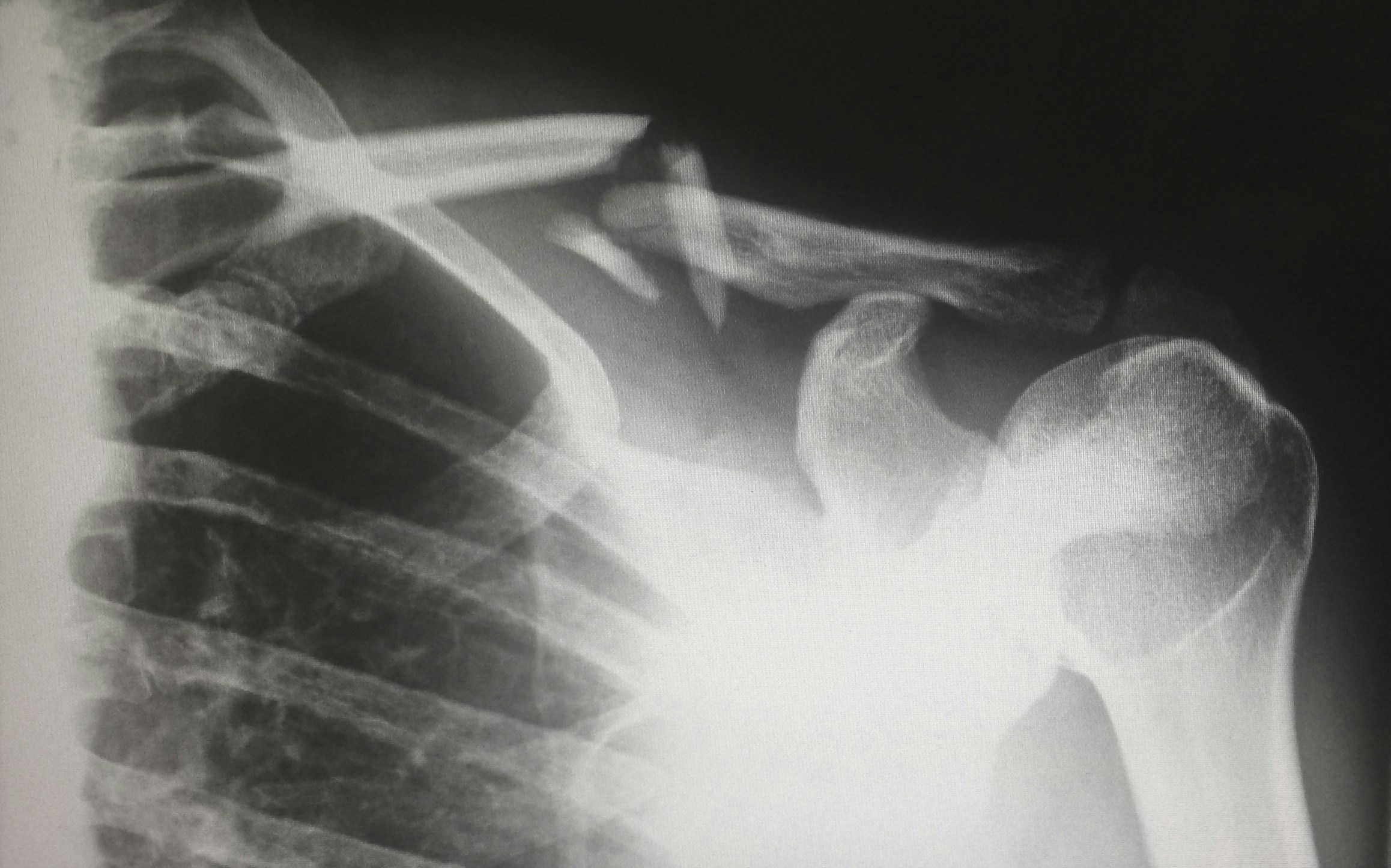 An X-ray of a human shoulder reveals a personal injury: a fractured clavicle with noticeable misalignment of the bone.